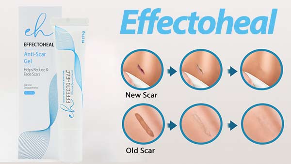 افکتوهیل برای درمان جای زخم بخیه