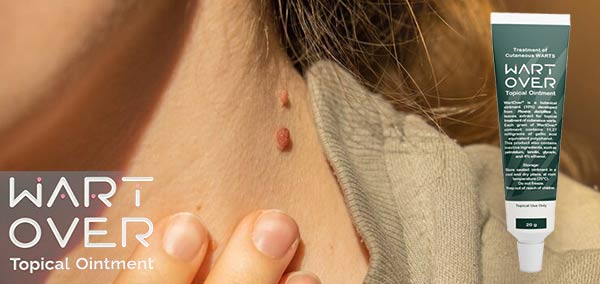 کرم وارت اور برای درمان زگیل تناسلی