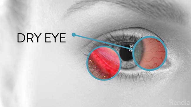 جلوگیری از خشکی چشم با ژل لیپوزیک بوش اند لامب