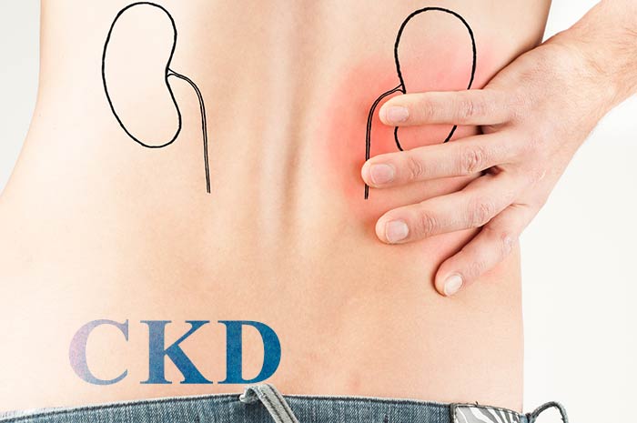 نارسایی مزمن کلیوی یا ckd چیست