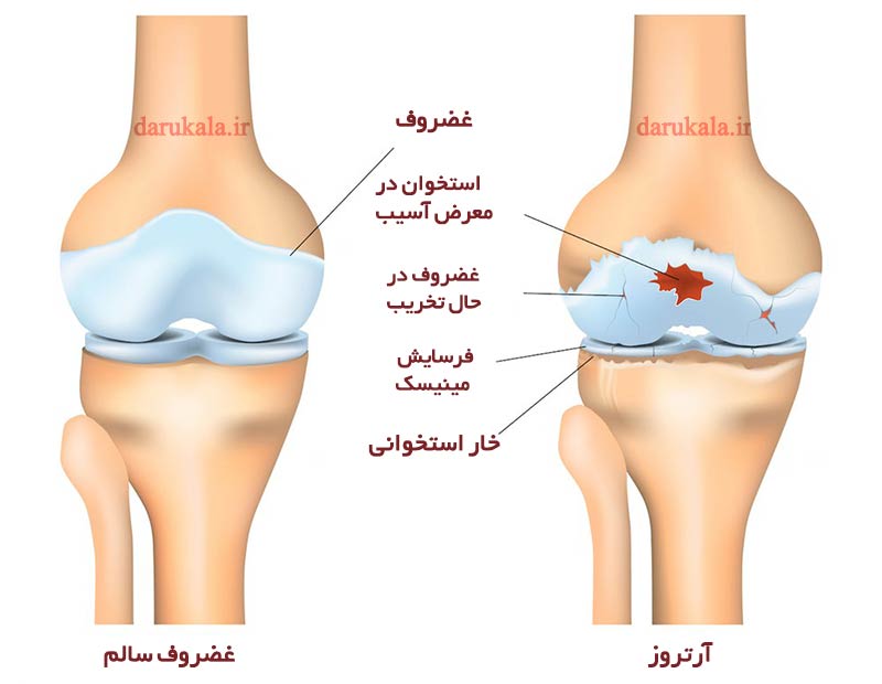 فواید گلوکزامین و کندرویتین