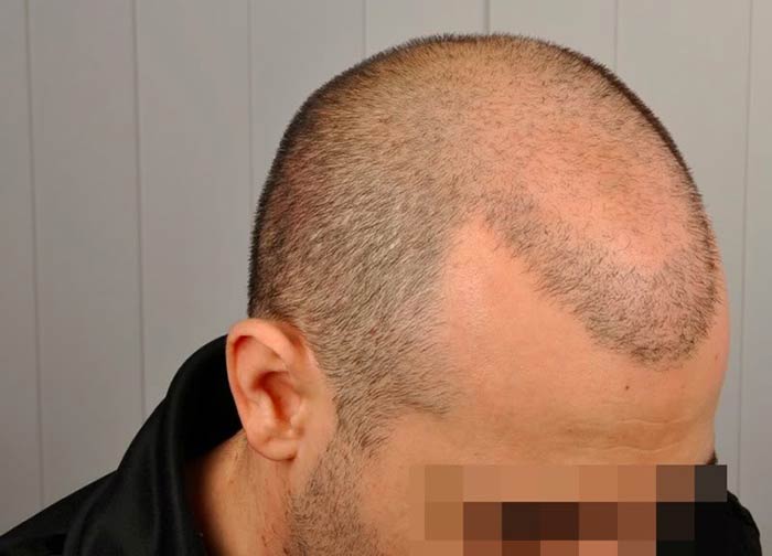 کاشت مو چیست