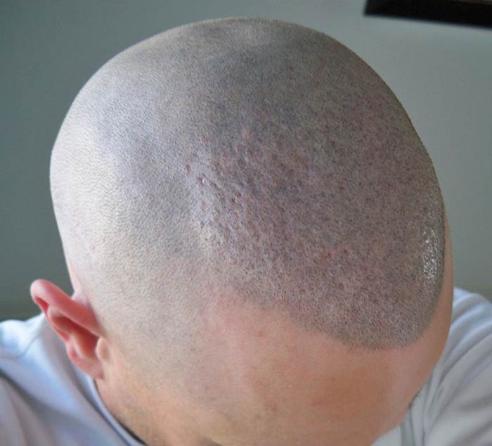 کاشت مو چقدر طول می کشد