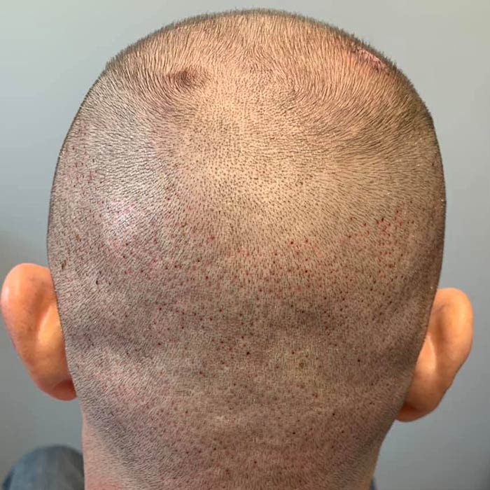 خرید شامپو برای موهای کاشته شده