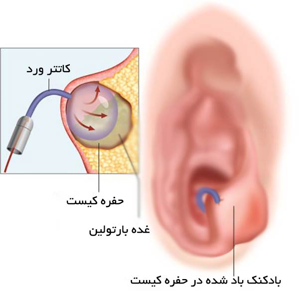 کیست بارتولین