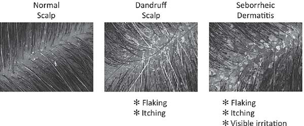 تفاوت شوره و سبوره مو