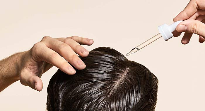 درمان ریزش موی سکه ای با لوسیون تریکوپلاس