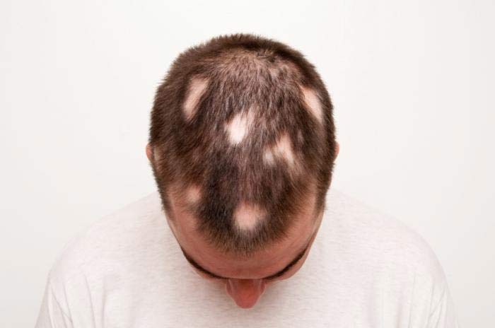 بیماری ریزش موی سکه ای و درمان آن در داروخانه آنلاین داروکالا