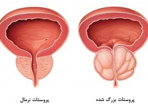 پروستات