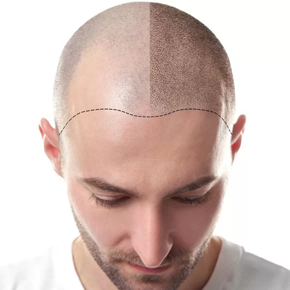 حفاظت از موهای کاشته شده را در داروکالا بخوانید