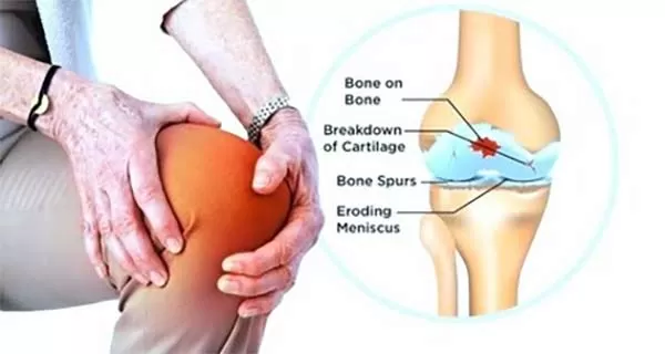 کلاژن نوع ۲ برای سلامت غضروف ها و مفاصل