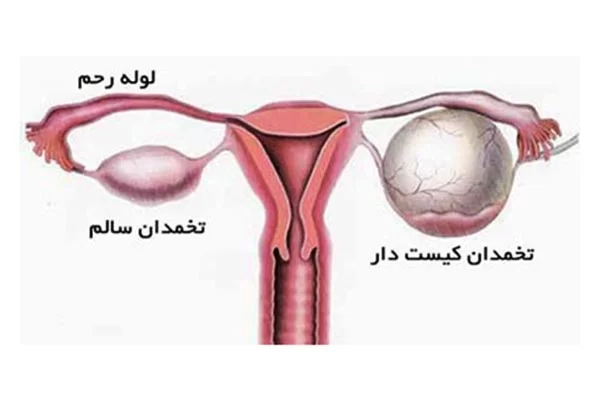 کیست تخمدان چیست
