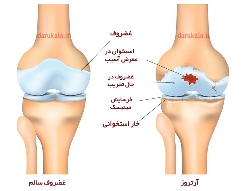 فواید گلوکزامین و کندرویتین 