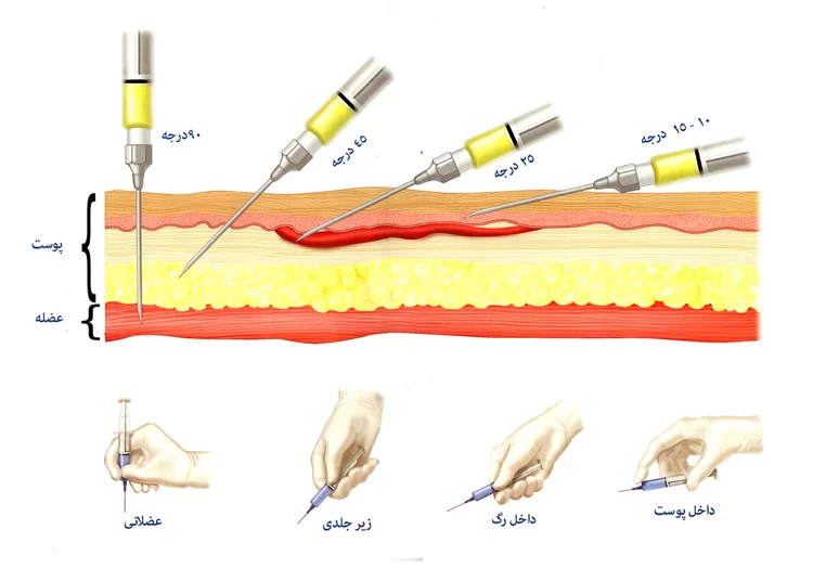 انواع تزریق تزریق زیرجلدی 