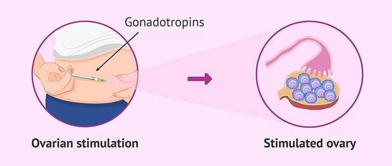 آمپول پیورگان برای کمک به بارداری زنان