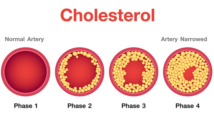 کاهش کلسترول با کپسول پرونوتری ولبیینگ کلسترول رستا دارو